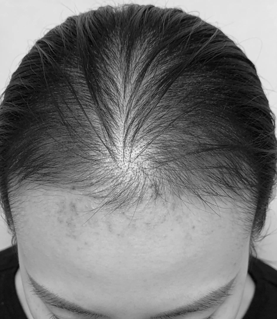 Hair Fall Results